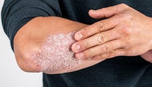 Soulager le psoriasis avec les huiles essentielles
